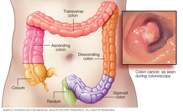 Colon Cancer